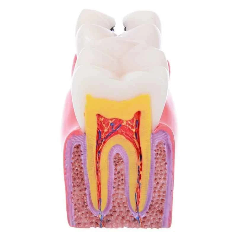 Dental Dynamics 6/8 Tooth Caries Comparison Model - Inspire Your Dentistry Skills with This Anatomical Teaching Tool!