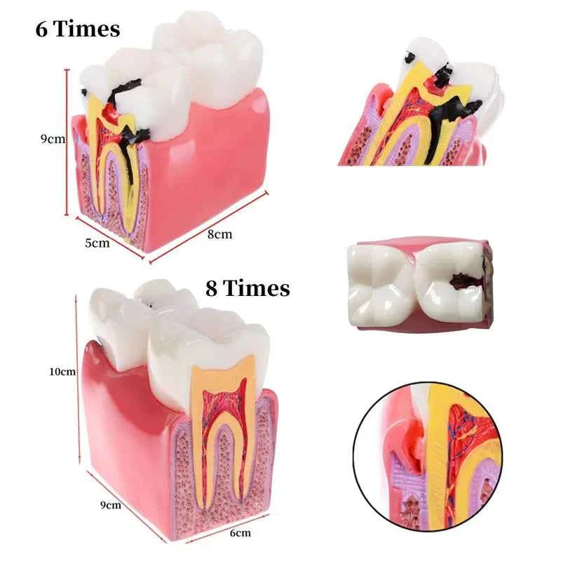 Dental Dynamics 6/8 Tooth Caries Comparison Model - Inspire Your Dentistry Skills with This Anatomical Teaching Tool!