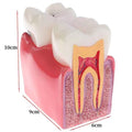 Dental Dynamics 6/8 Tooth Caries Comparison Model - Inspire Your Dentistry Skills with This Anatomical Teaching Tool!