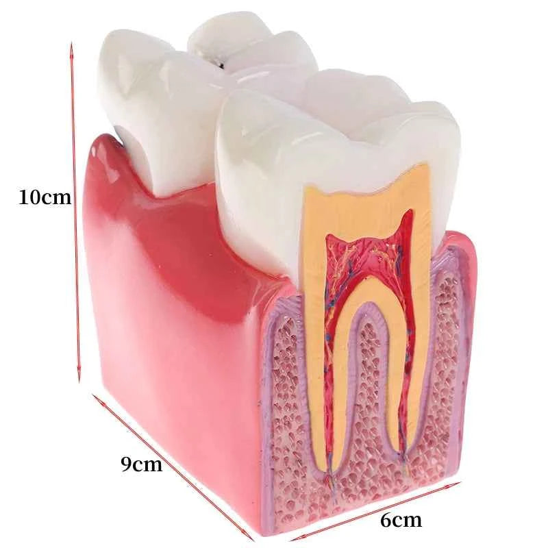 Dental Dynamics 6/8 Tooth Caries Comparison Model - Inspire Your Dentistry Skills with This Anatomical Teaching Tool!