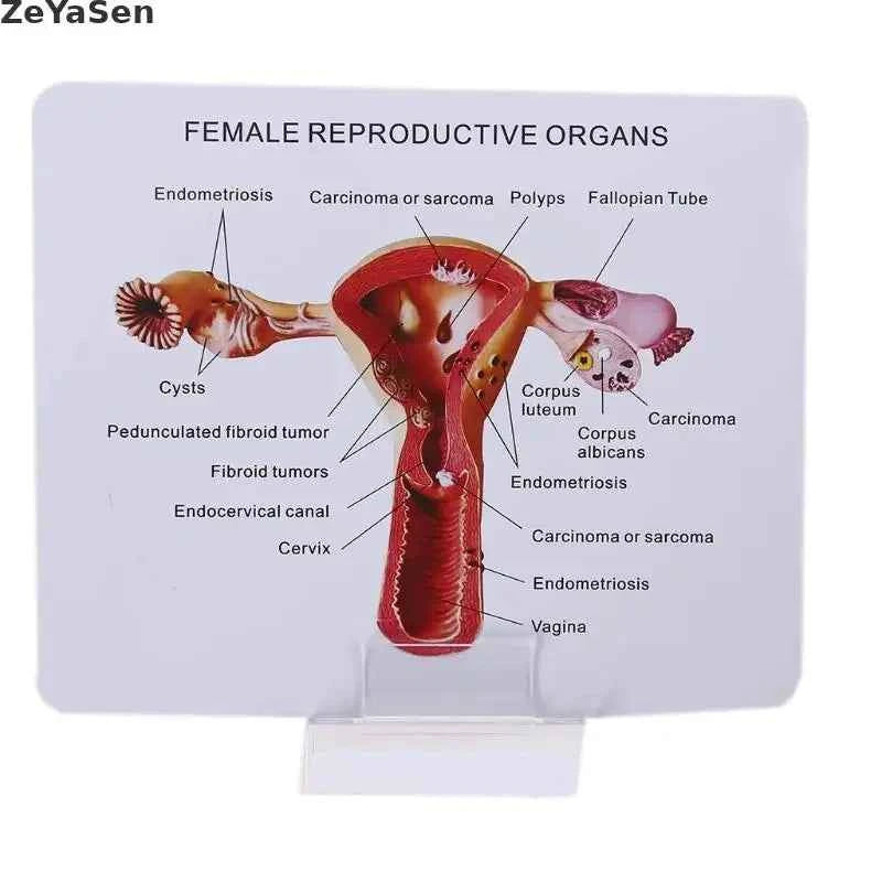 Medical props model Human Female Pathological Uterus Ovary Model Anatomical Disease Pathology Medical Lesion ForBiology Teaching