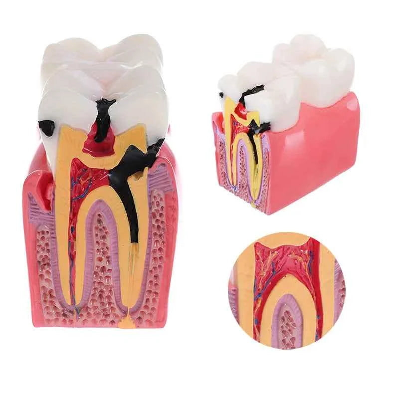 Dental Dynamics 6/8 Tooth Caries Comparison Model - Inspire Your Dentistry Skills with This Anatomical Teaching Tool!