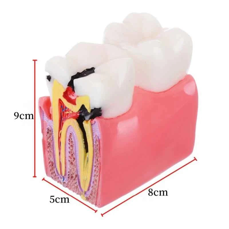 Dental Dynamics 6/8 Tooth Caries Comparison Model - Inspire Your Dentistry Skills with This Anatomical Teaching Tool!