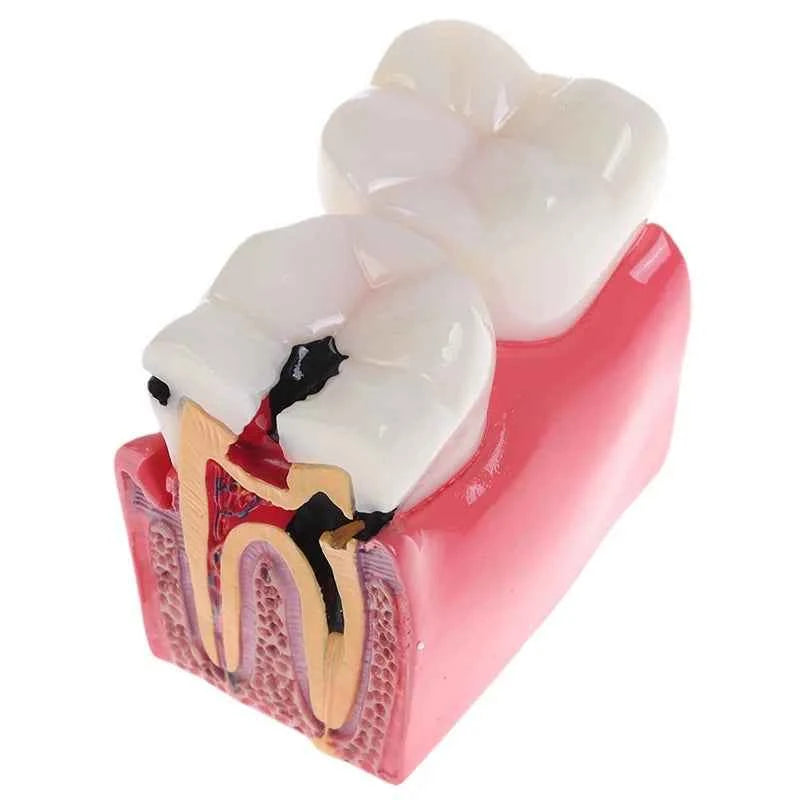 Dental Dynamics 6/8 Tooth Caries Comparison Model - Inspire Your Dentistry Skills with This Anatomical Teaching Tool!