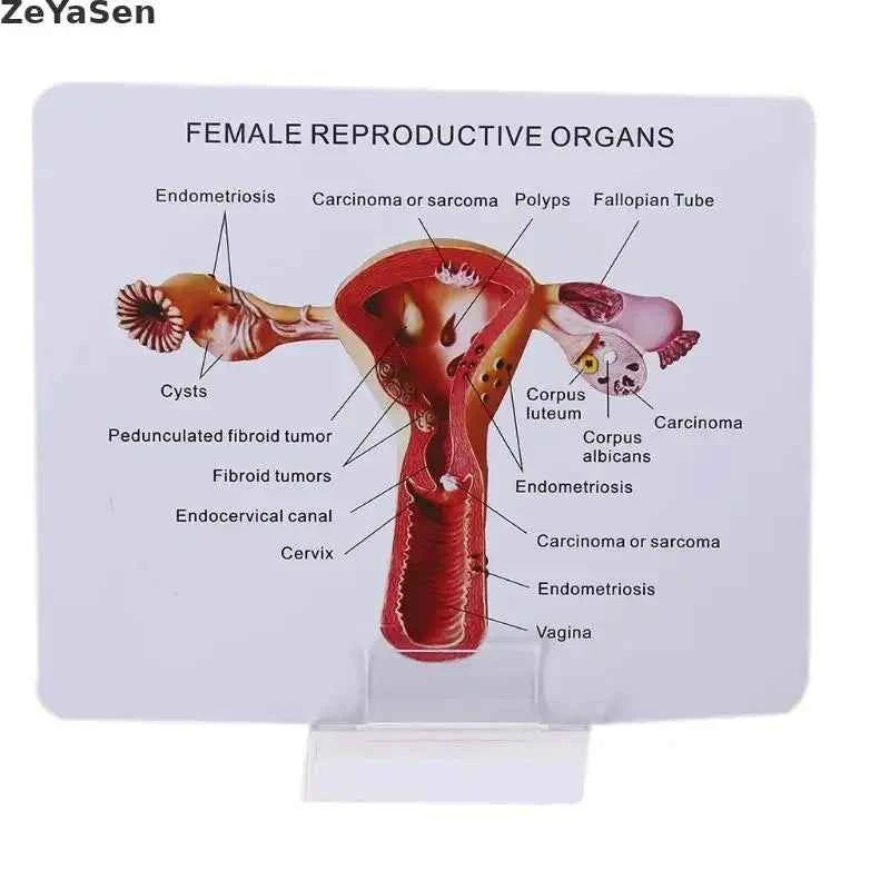 Medical props model Human Female Pathological Uterus Ovary Model Anatomical Disease Pathology Medical Lesion ForBiology Teaching