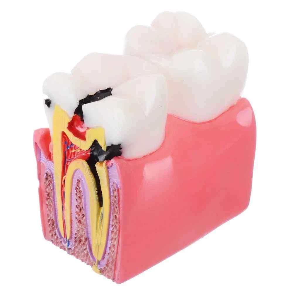 Dental Dynamics 6/8 Tooth Caries Comparison Model - Inspire Your Dentistry Skills with This Anatomical Teaching Tool!